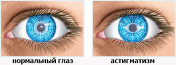 Нормальный глаз и глаз при астигматизме